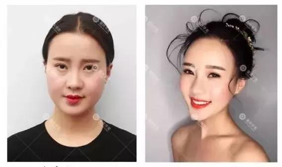 能瘦臉，又能除皺的瘦臉針，了解一下！