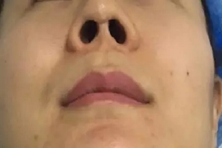 隆鼻手術(shù)切口在哪里？才能自然不留疤