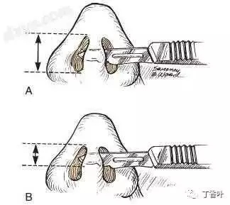 隆鼻手術(shù)切口在哪里？才能自然不留疤
