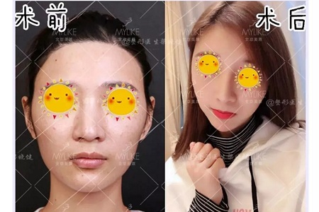 隆鼻手術(shù)切口在哪里？才能自然不留疤