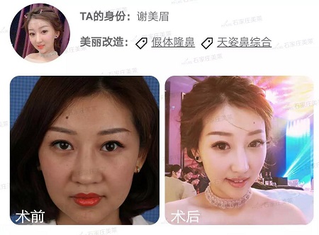 做了假體隆鼻后，變化有多大！看4個(gè)案例對(duì)比