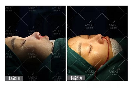 顏值：鼻子的改變能讓一個女孩變化有多大？