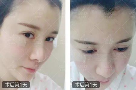 顏值：做完自體脂肪填充15天后，她變啥樣了？