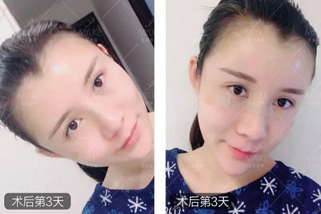 顏值：做完自體脂肪填充15天后，她變啥樣了？