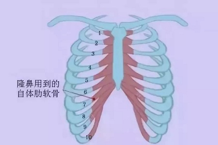 什么，隆鼻方式竟然有這么多種？