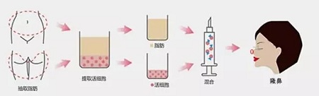 什么，隆鼻方式竟然有這么多種？