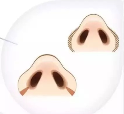 “鼻”需“整”救重磅開啟，你的鼻子即將C位出道了！