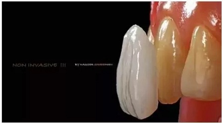 牙齒發(fā)黃怎么辦？還有救嗎？