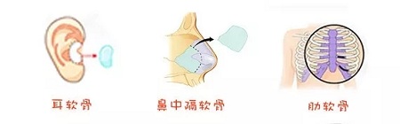 糾結！鼻頭太圓想塑形是用肋軟骨還是耳軟骨好？