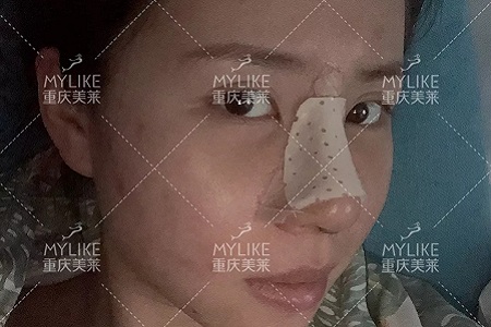 糾結！鼻頭太圓想塑形是用肋軟骨還是耳軟骨好？