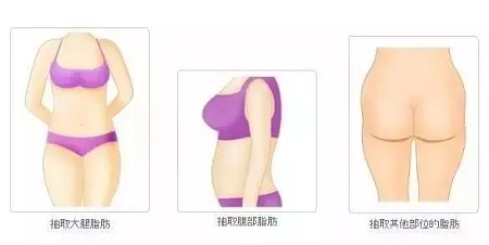 讓明星“一夜回春”的自體脂肪到底適不適合你？