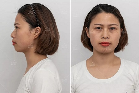 讓明星“一夜回春”的自體脂肪到底適不適合你？