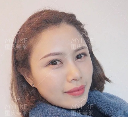 讓明星“一夜回春”的自體脂肪到底適不適合你？