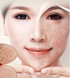 問(wèn)診室：祛斑后皮膚能年輕十歲？關(guān)于祛斑的這些問(wèn)題你知道嗎？