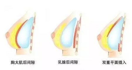 自體脂肪or假體隆胸，我到底應(yīng)該怎么選？