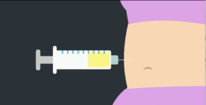 自體脂肪or假體隆胸，我到底應(yīng)該怎么選？