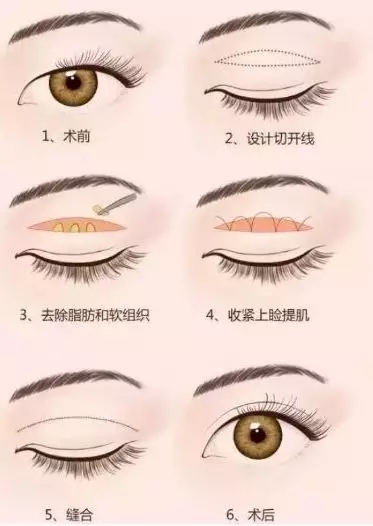 問診室：做雙眼皮前，這些問題你需要提前了解！