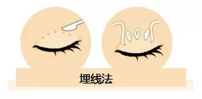 雙眼皮我想做埋線，為什么醫(yī)師建議我做全切雙眼皮