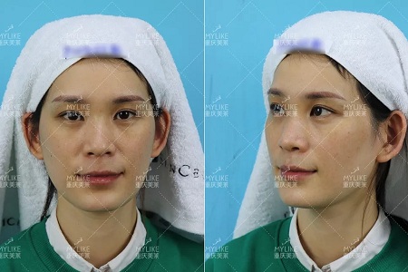 那個(gè)斑點(diǎn)女孩后來怎么樣了？