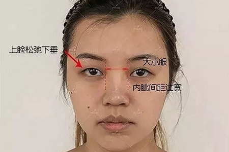 大小眼、不對(duì)稱，你是長(zhǎng)胖了還是真老了？