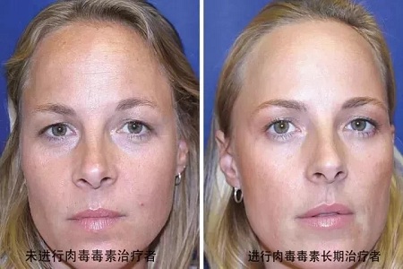 你無(wú)法用玻尿酸除掉所有皺紋！