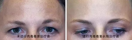 你無(wú)法用玻尿酸除掉所有皺紋！