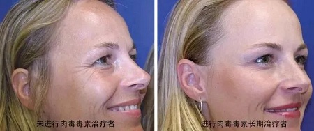 你無(wú)法用玻尿酸除掉所有皺紋！