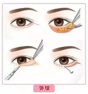 每到放假，做這個項目的人就會增多！--眼袋