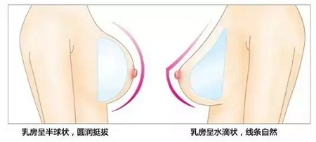 要不要隆胸，你對(duì)豐胸手術(shù)了解多少？