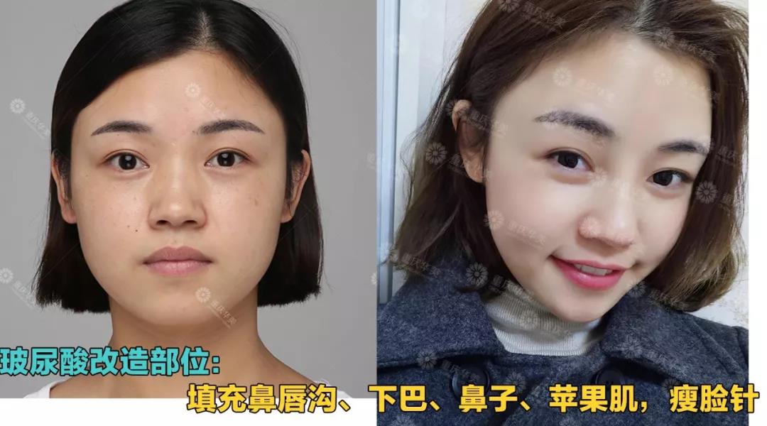 玻尿酸+瘦臉這樣打，方臉、大餅臉都能變小V臉！