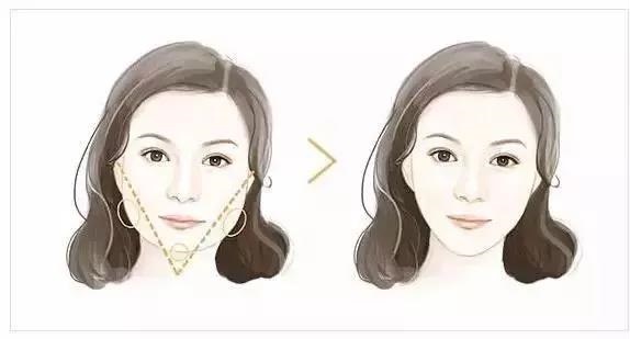 玻尿酸+瘦臉這樣打，方臉、大餅臉都能變小V臉！