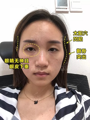 自體脂肪+雙眼皮，這對(duì)cp你不pick一下嗎？