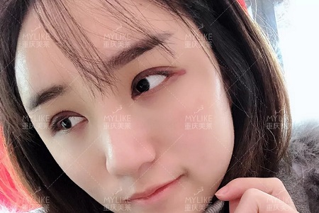 自體脂肪+雙眼皮，這對(duì)cp你不pick一下嗎？