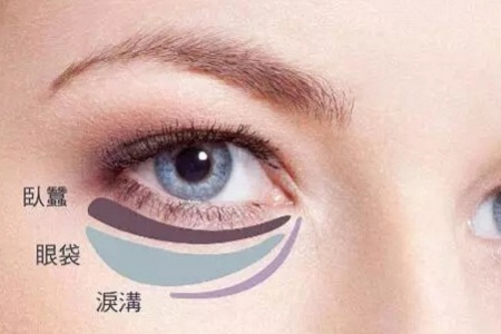 去掉眼袋，刻不容緩，別等又大又松弛才做