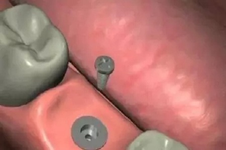 揭秘牙齒矯正的全過程！??！