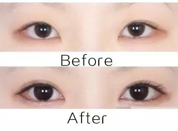 美萊實(shí)驗(yàn)室：開眼角就是醫(yī)師想多收錢？