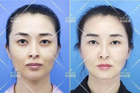 顯老淚溝，你還要任其放肆嗎？