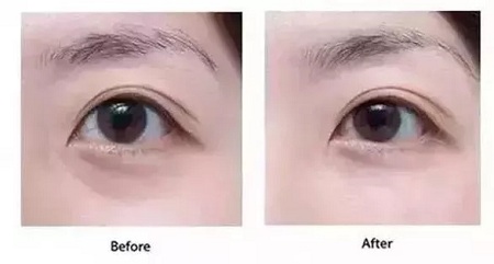 顯老淚溝，你還要任其放肆嗎？