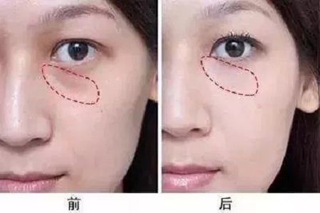 顯老淚溝，你還要任其放肆嗎？