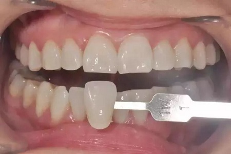 牙齒也能敷“面膜”？這款明星美牙秘籍了解下