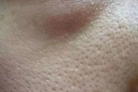 粗糙、毛孔粗大、起皮......換季肌膚問題如何解決？