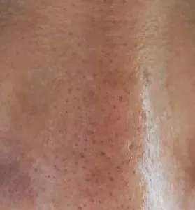 粗糙、毛孔粗大、起皮......換季肌膚問題如何解決？