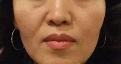 用玻尿酸治療鼻唇溝，一定要注意這種情況！