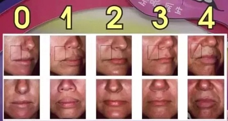 用玻尿酸治療鼻唇溝，一定要注意這種情況！