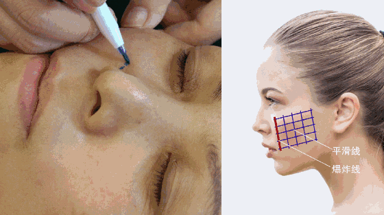 用玻尿酸治療鼻唇溝，一定要注意這種情況！