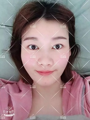 面部填充會(huì)不會(huì)把臉填大？