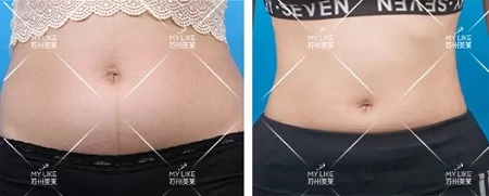 夏天到了，你想過(guò)吸脂讓自己瘦下來(lái)嗎？