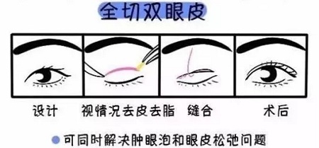 美眼張誠坐診美萊，淺談為什么你的眼睛不夠美？