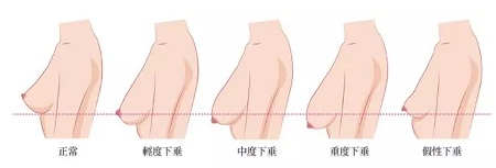 一味追求大胸的她們，卻忽略了這個問題...