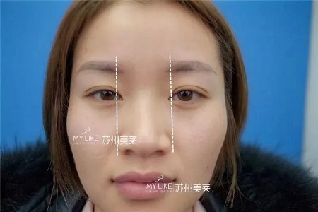 鼻子不是越高越好看！